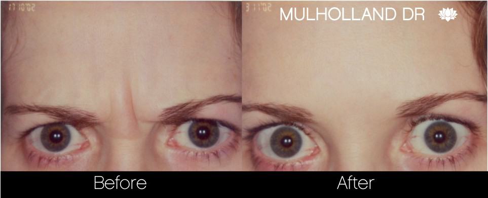 Botox Injectable - Before and After Gallery – Photo 8