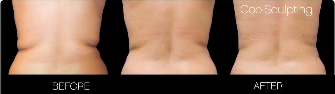 CoolSculpting - Before and After Gallery – Photo 8