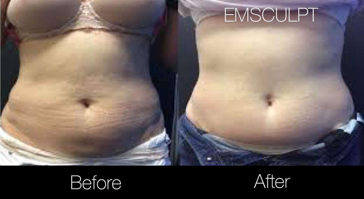 Emsculpt - Before and After Gallery – Photo 8