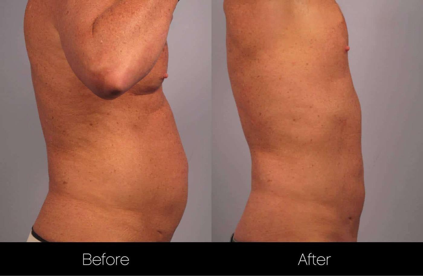 Non-Surgical Liposuction - Before and After Gallery – Photo 8