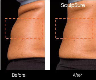 SculpSure - Before and After Gallery – Photo 10