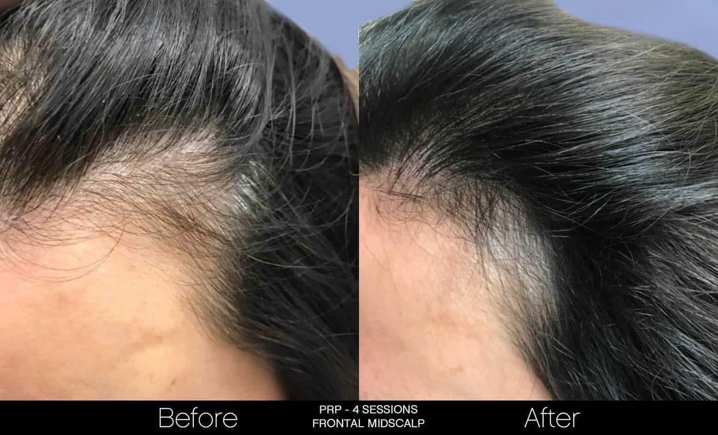 Non-Surgical Hair Restoration - Patient Before and After Gallery – Photo 8