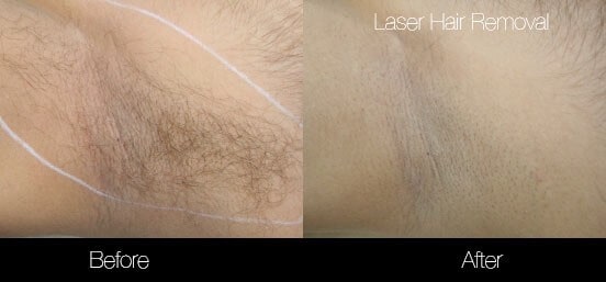 Laser Hair Removal - Patient Before and After Gallery – Photo 8