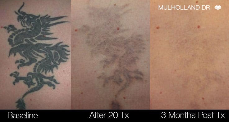 Laser Tattoo Removal  Essentials MediSpa