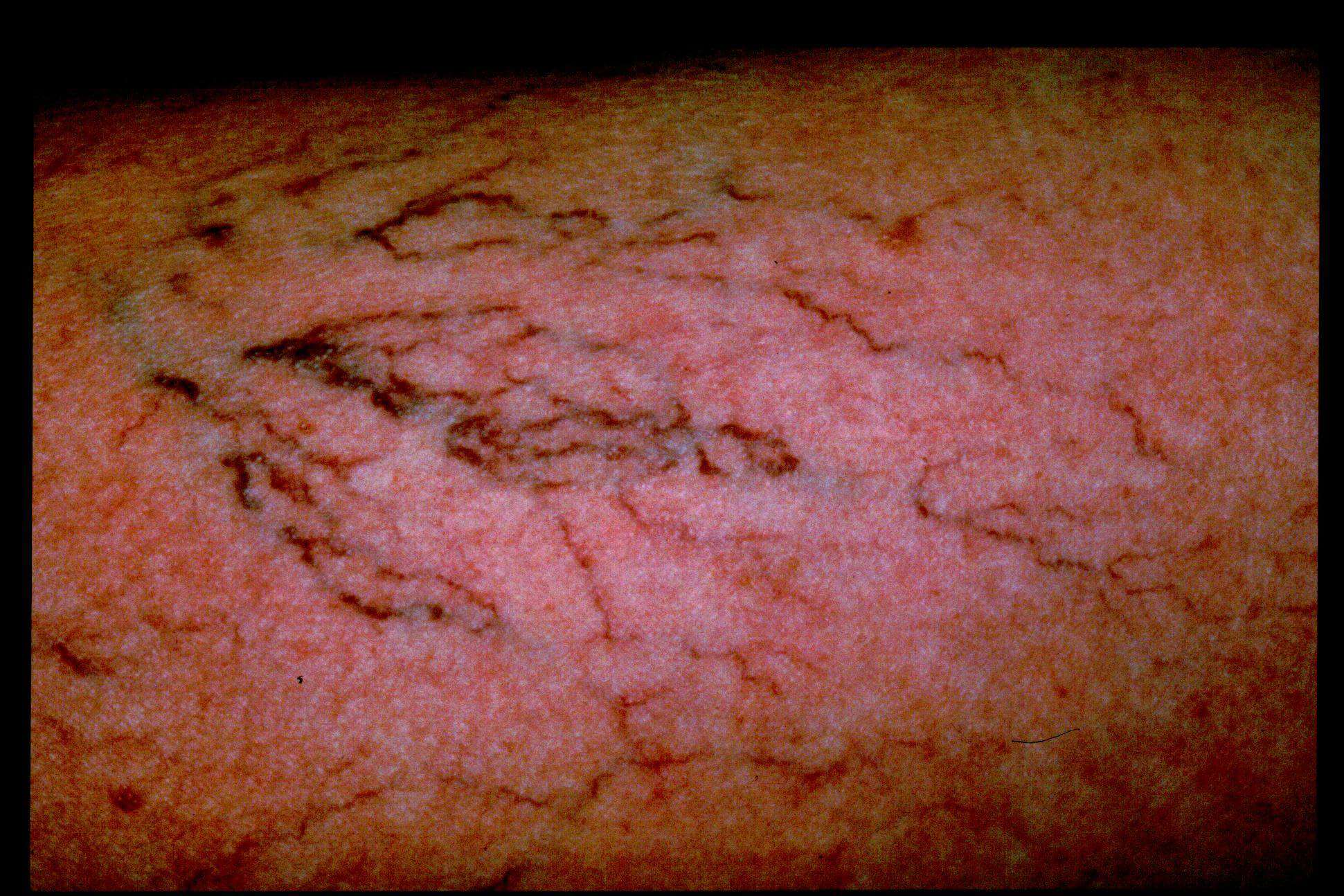 Leg Vein Reduction - Patient Before and After Gallery – Photo 8