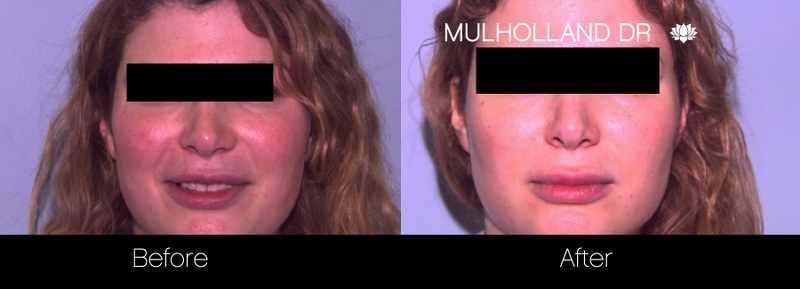 Rosacea Treatment - Patient Before and After Gallery – Photo 2