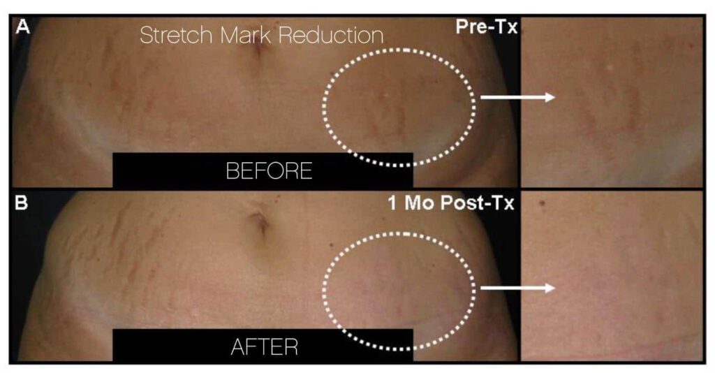 How To Get Rid Of Stretch Marks Toronto SpaMedica