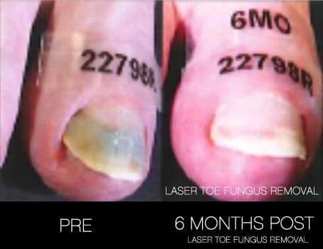 Toe Fungus Removal - Patient Before and After Gallery – Photo 8