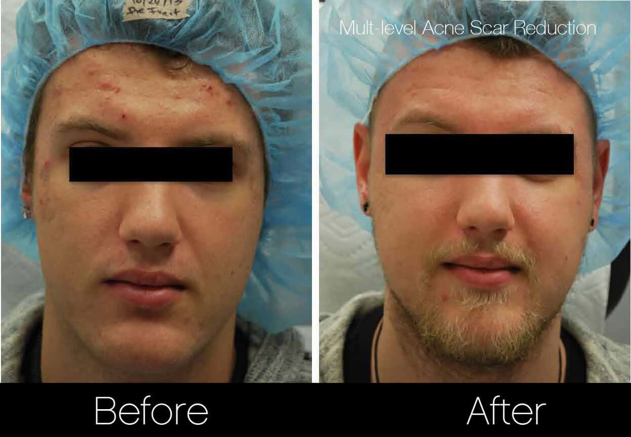 Acne Scar Treatments - Before and After Gallery – Photo 9