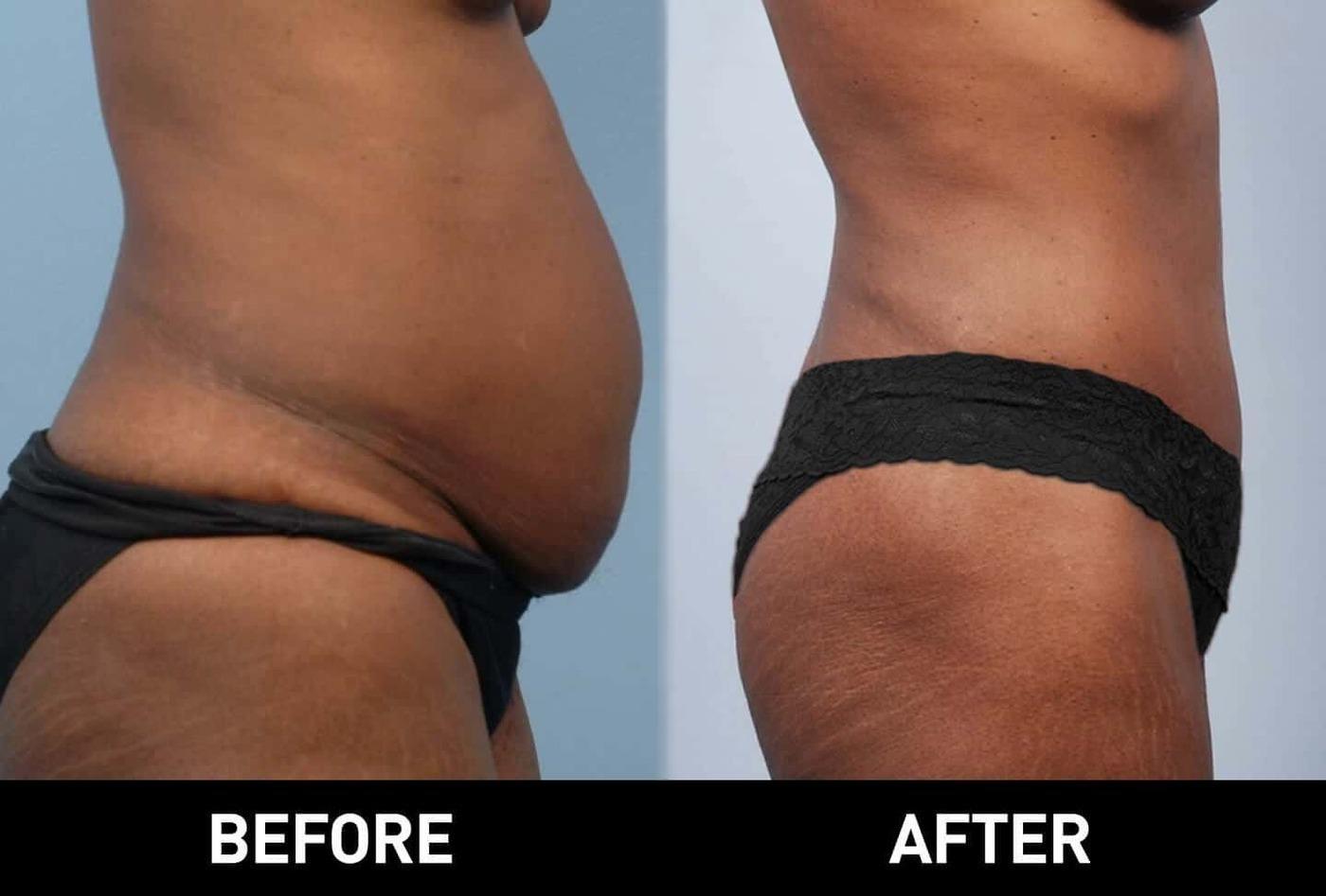 Smart Lipo - Before and After Gallery – Photo 8