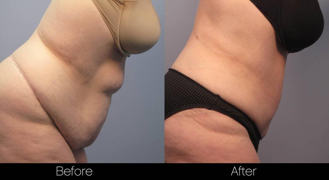 Tummy Tuck - Before and After Gallery – Photo 8