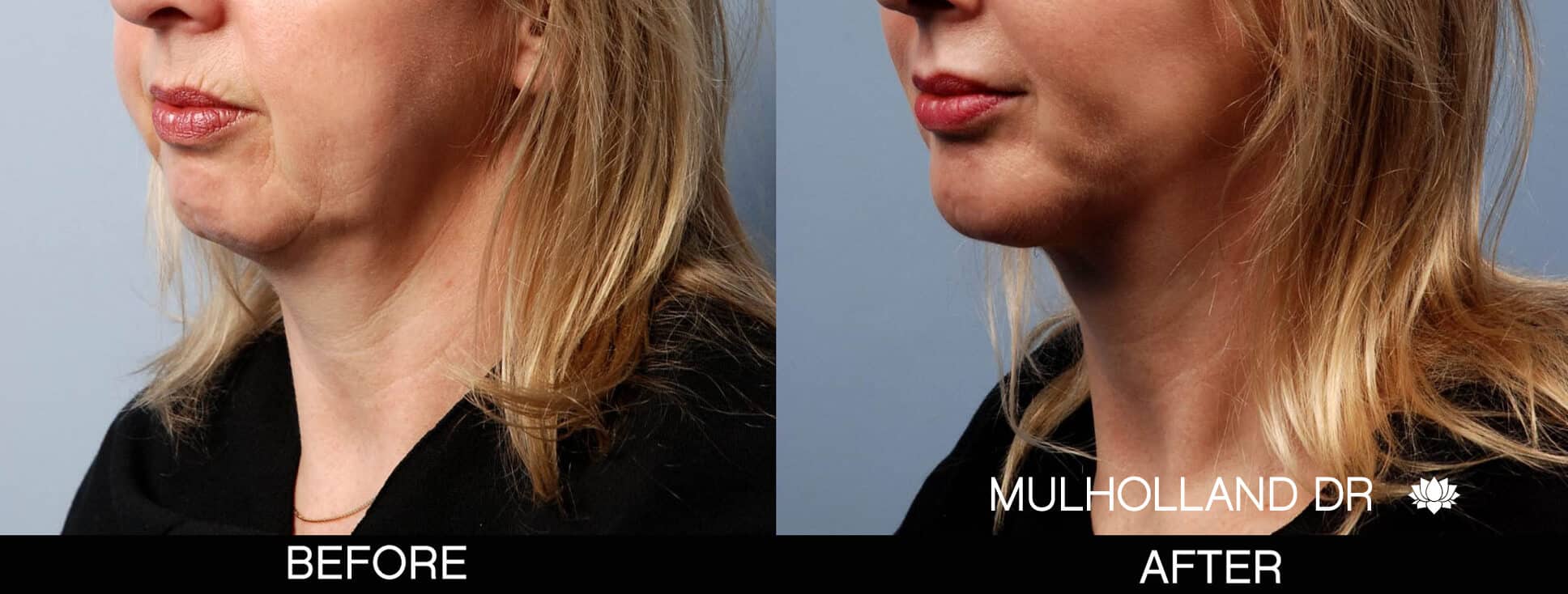 Chin Implant - Before and After Gallery – Photo 8
