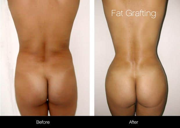 Brazilian Butt Lift - Before and After Gallery – Photo 8