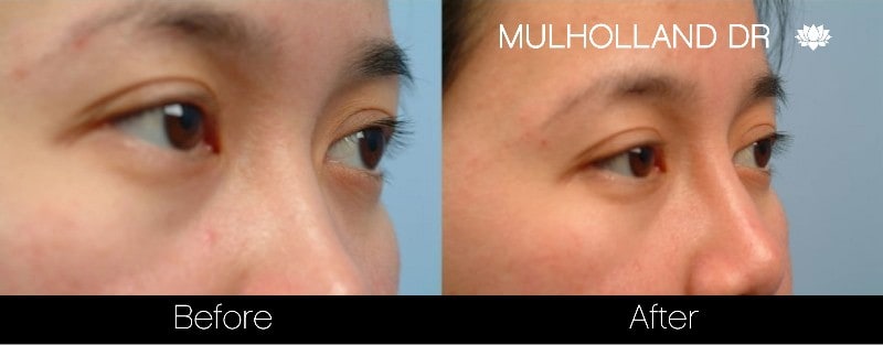 5 Minute Nose Job - Before and After Gallery – Photo 9