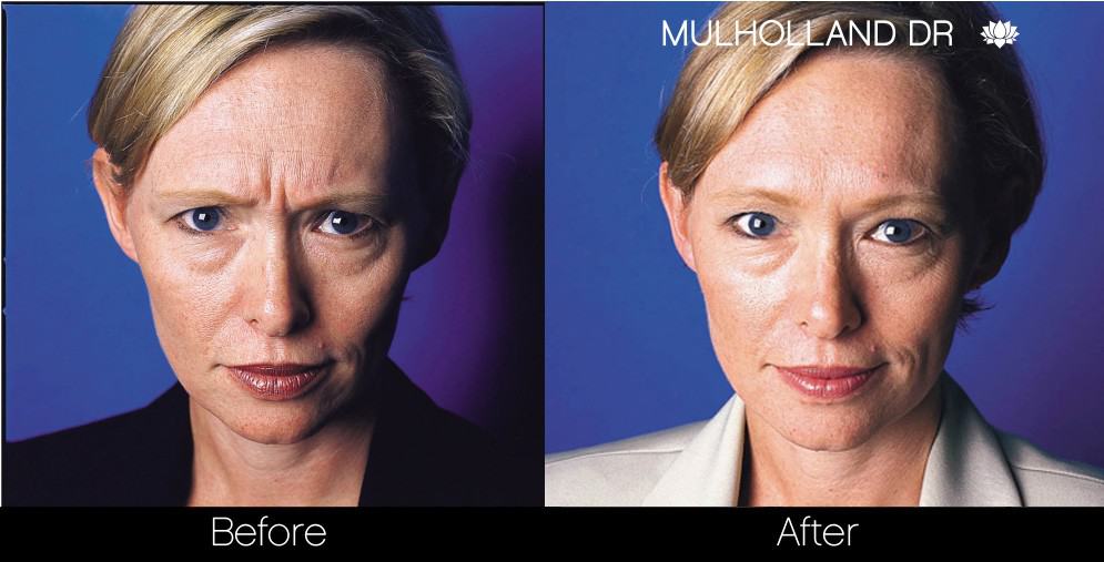 Botox Injectable - Before and After Gallery – Photo 9