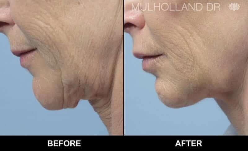 Non-Surgical Facelift - Before and After Gallery – Photo 9