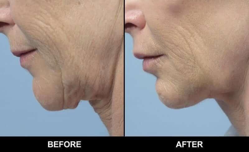 Non-Surgical Facelift - Before and After Gallery – Photo 9