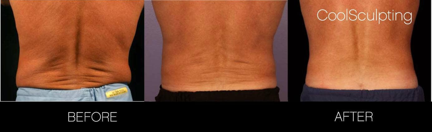 CoolSculpting - Before and After Gallery – Photo 9