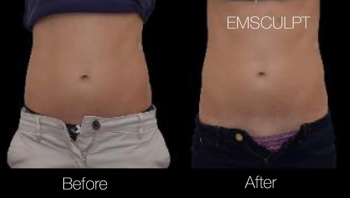 Emsculpt - Before and After Gallery – Photo 9
