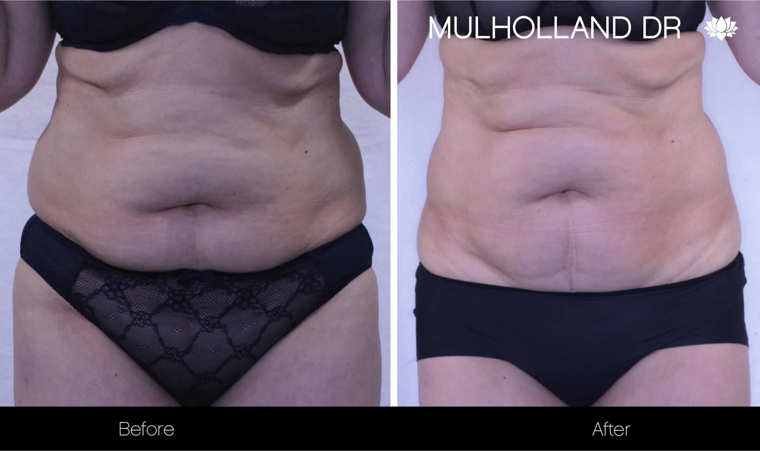 Non-Surgical Liposuction - Before and After Gallery – Photo 9