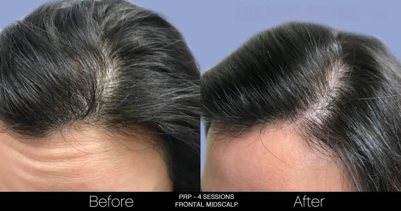 Non-Surgical Hair Restoration - Patient Before and After Gallery – Photo 9