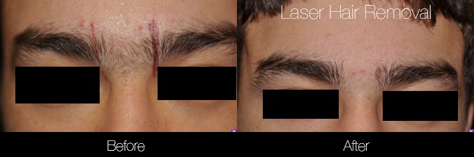 Laser Hair Removal - Patient Before and After Gallery – Photo 9