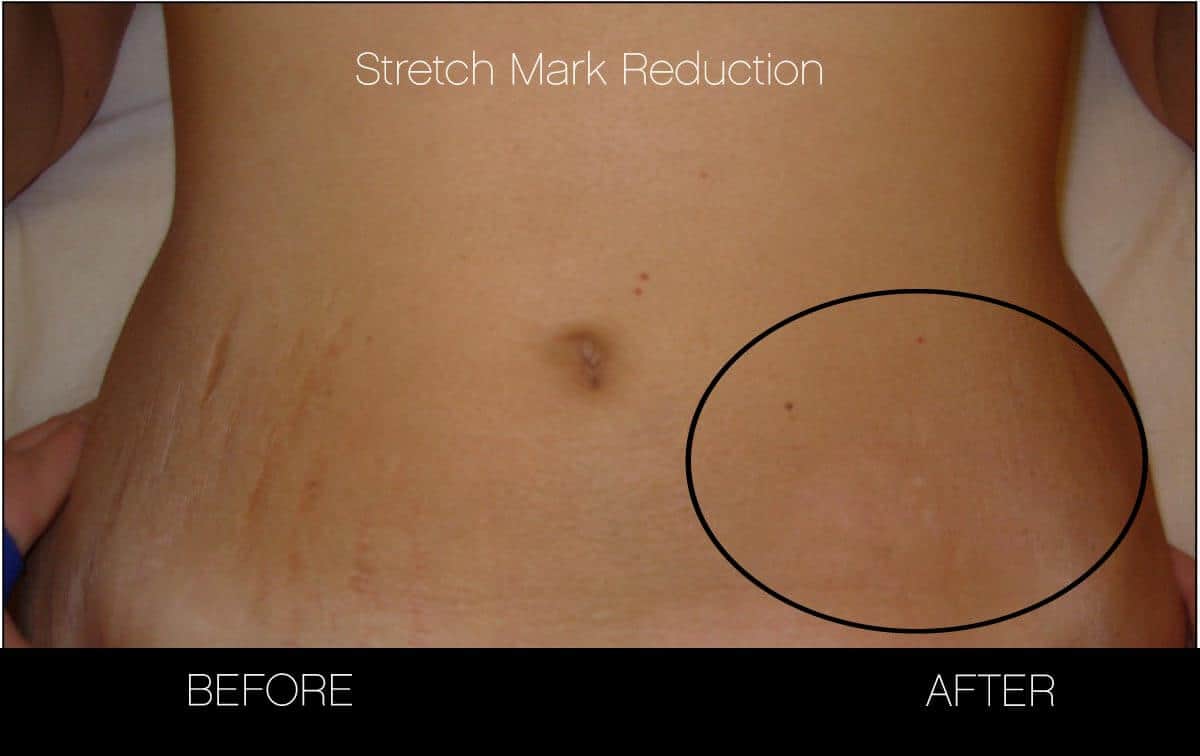 Laser Stretch Mark Removal - Patient 9