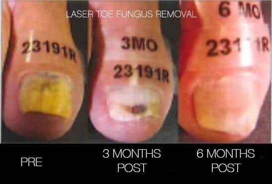 Toe Fungus Removal - Patient Before and After Gallery – Photo 9