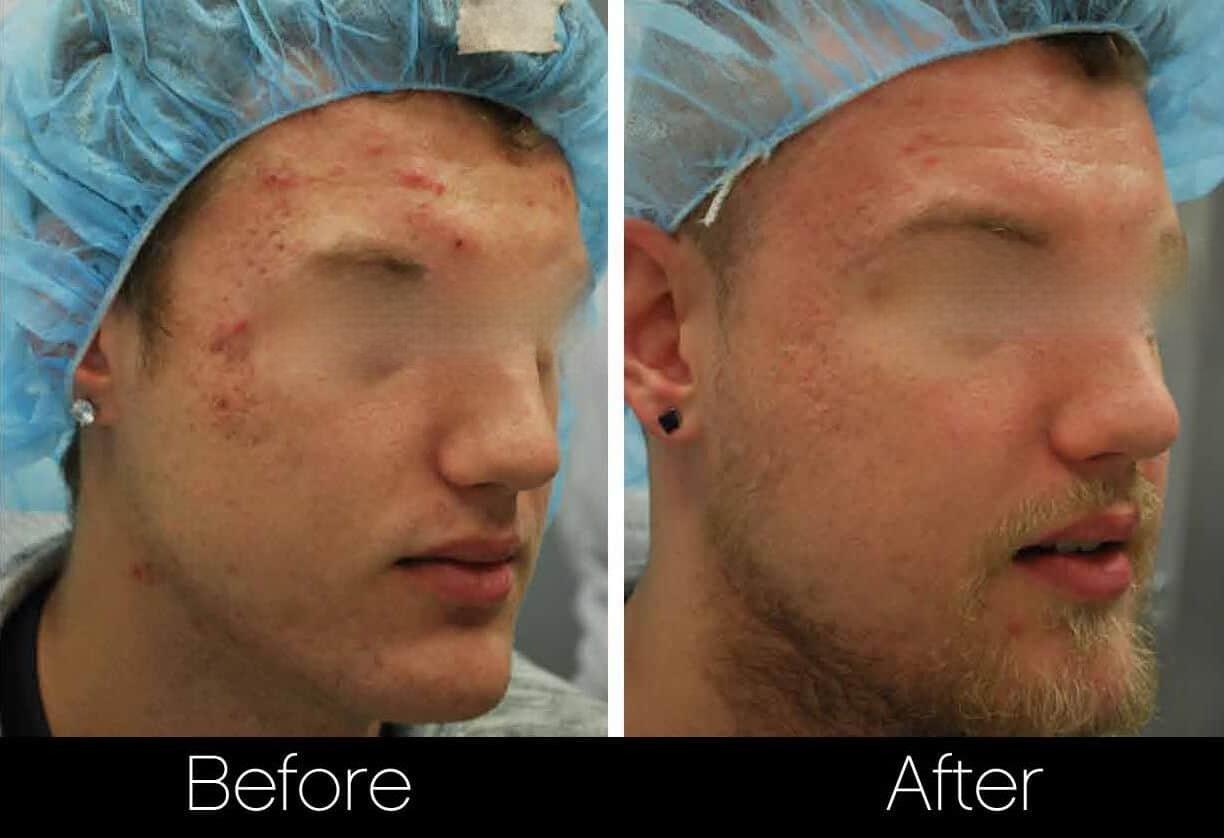 Acne Scar Treatments - Before and After Gallery – Photo 10