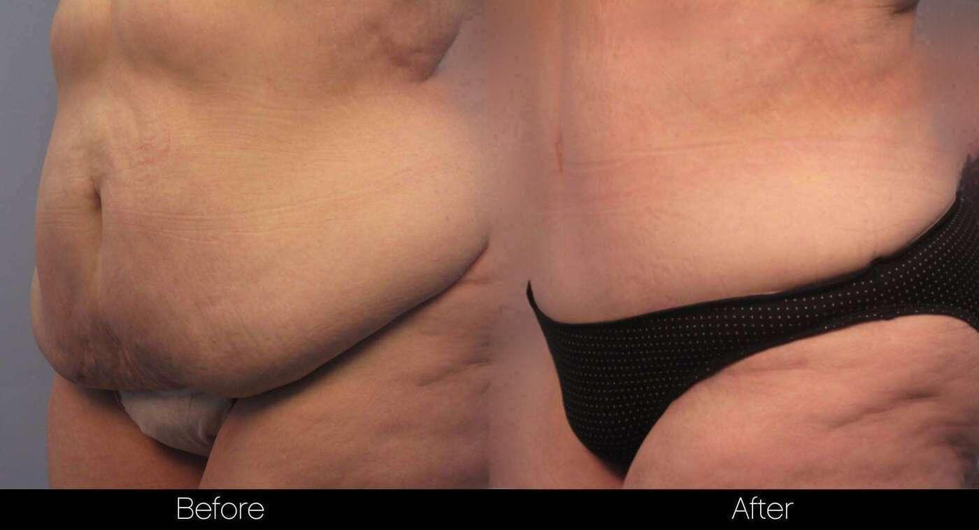 Tummy Tuck - Before and After Gallery – Photo 9