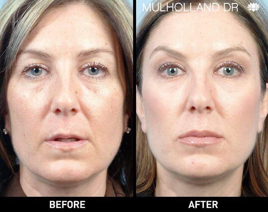 Soft Tissue Fillers - Patient Before and After Gallery – Photo 1