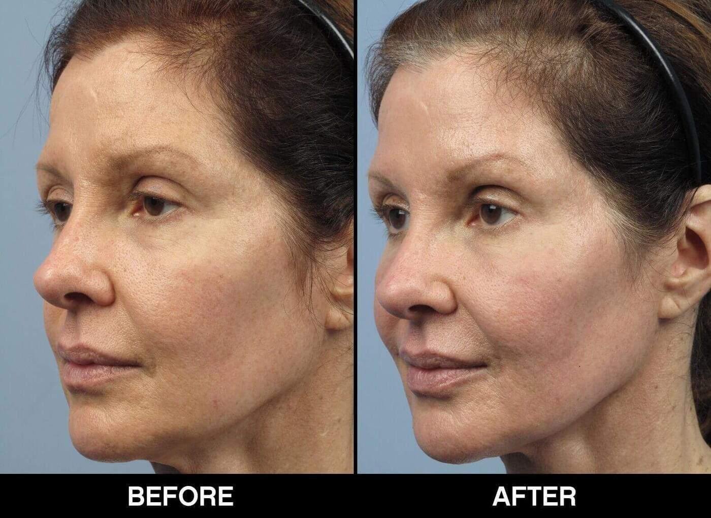 Soft Tissue Fillers - Patient Before and After Gallery – Photo 8