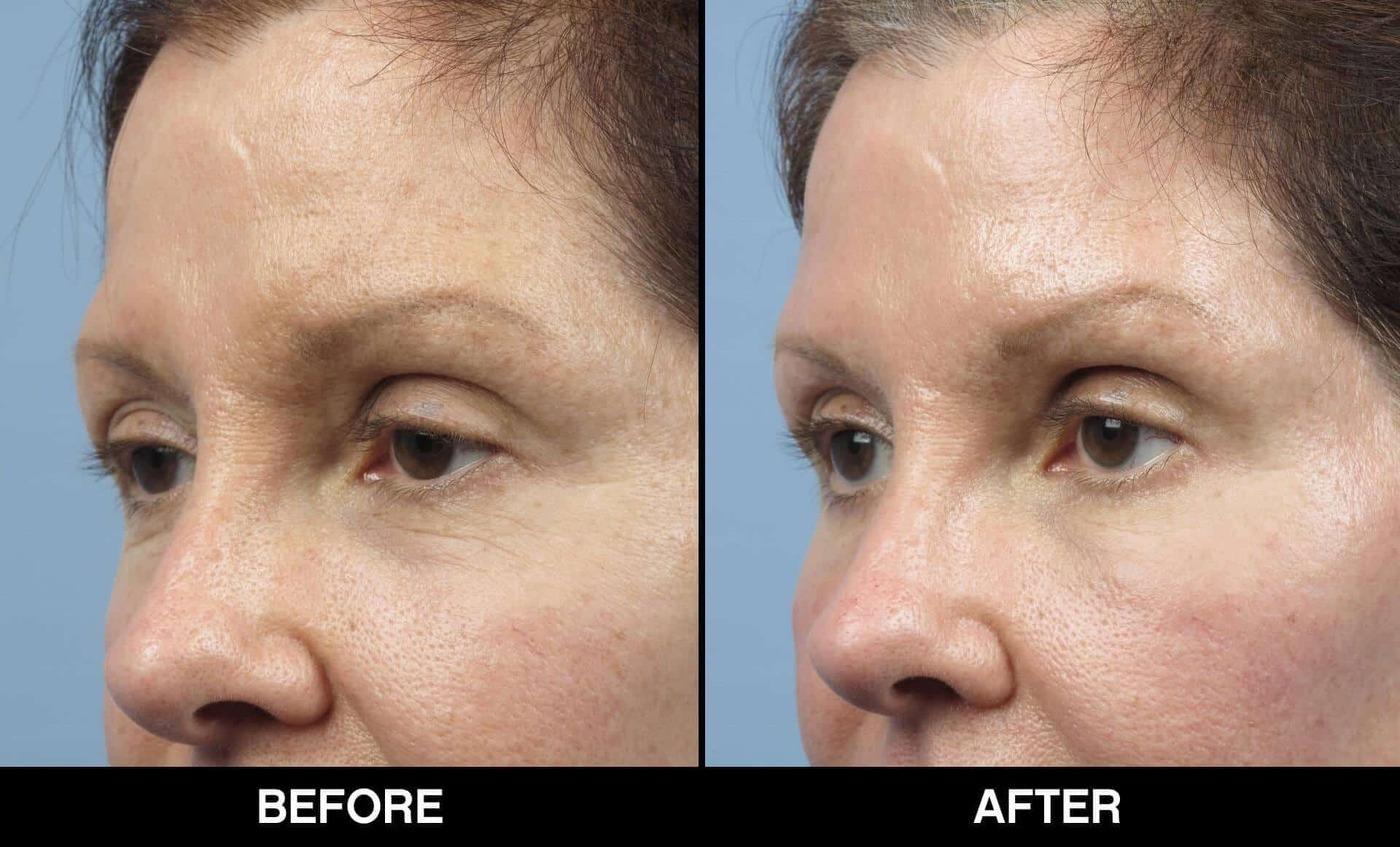 Soft Tissue Fillers - Patient Before and After Gallery – Photo 9
