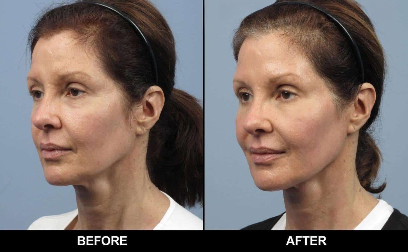 Soft Tissue Fillers - Patient Before and After Gallery – Photo 11