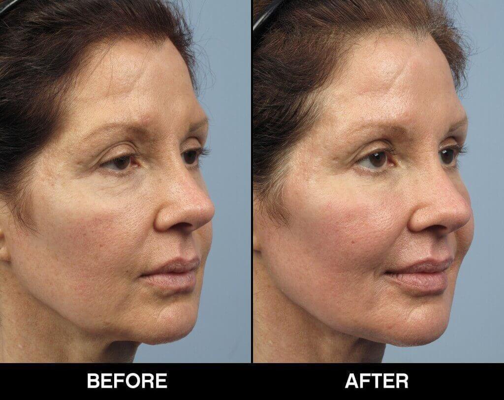 Soft Tissue Fillers - Patient Before and After Gallery – Photo 12