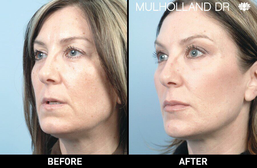 Soft Tissue Fillers - Patient Before and After Gallery – Photo 2