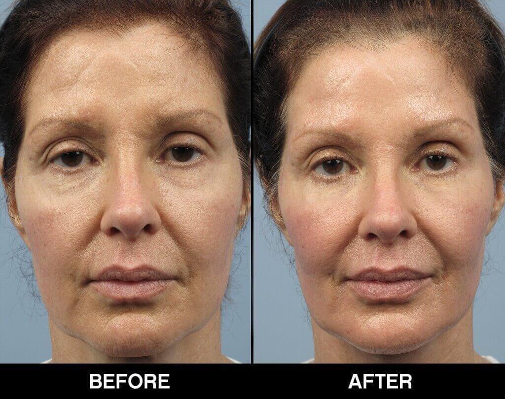 Soft Tissue Fillers - Patient Before and After Gallery – Photo 16