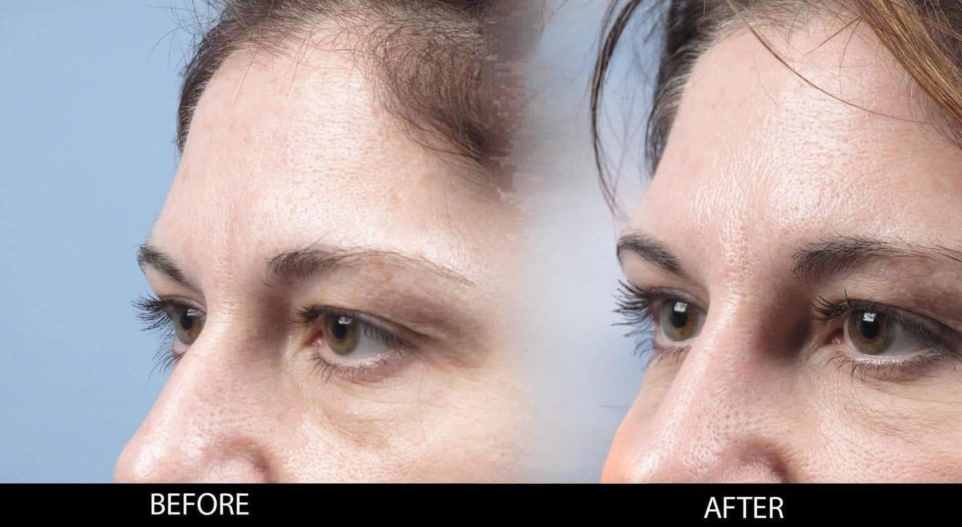 Soft Tissue Fillers - Patient Before and After Gallery – Photo 17