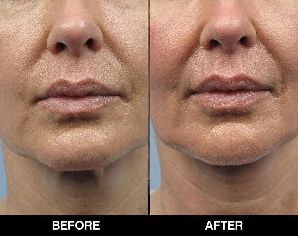 Soft Tissue Fillers - Patient Before and After Gallery – Photo 18