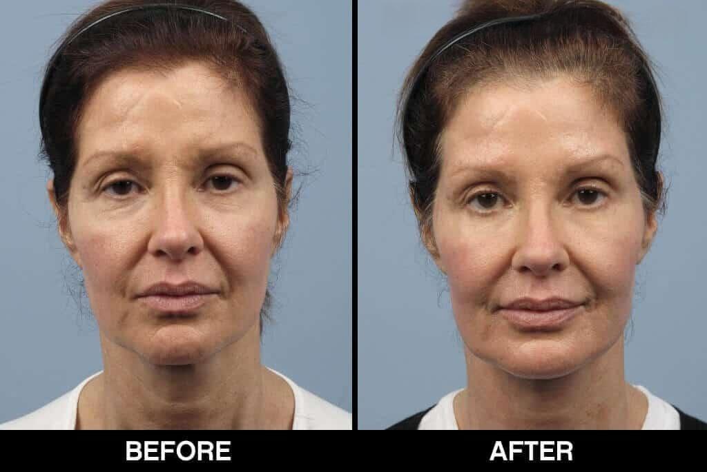 Soft Tissue Fillers - Patient Before and After Gallery – Photo 19