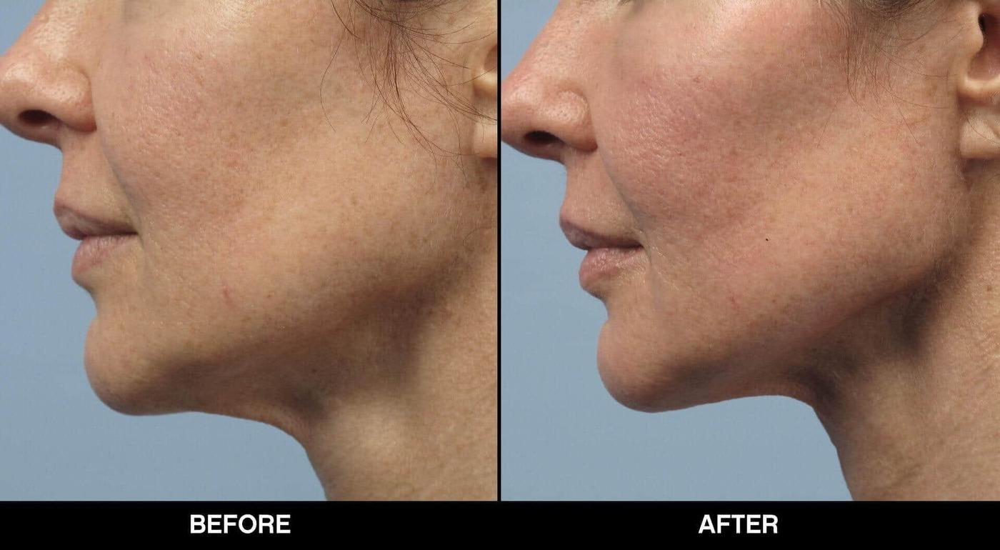 Soft Tissue Fillers - Patient Before and After Gallery – Photo 20