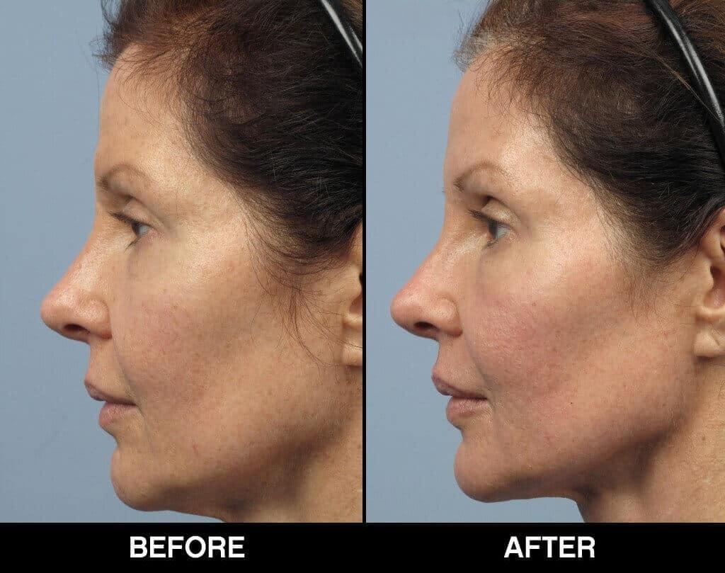 Soft Tissue Fillers - Patient Before and After Gallery – Photo 21