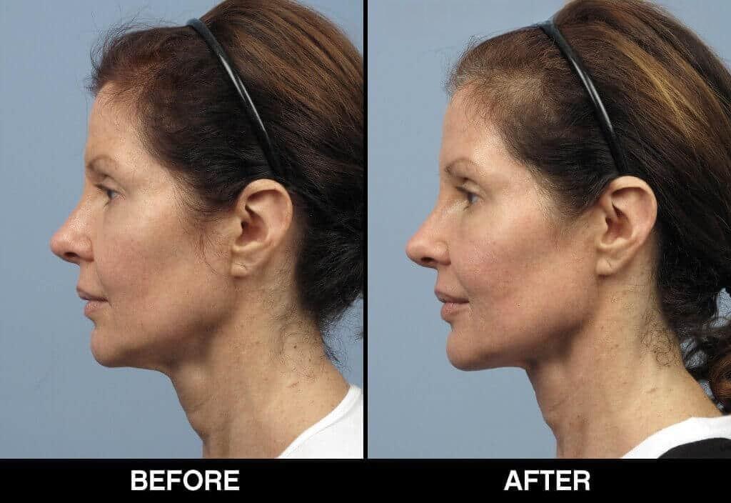 Soft Tissue Fillers - Patient Before and After Gallery – Photo 22