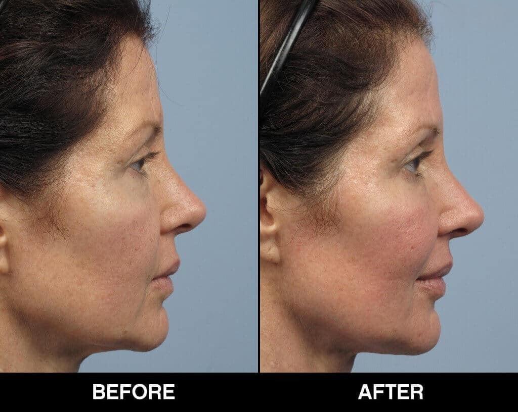 Soft Tissue Fillers - Patient Before and After Gallery – Photo 23