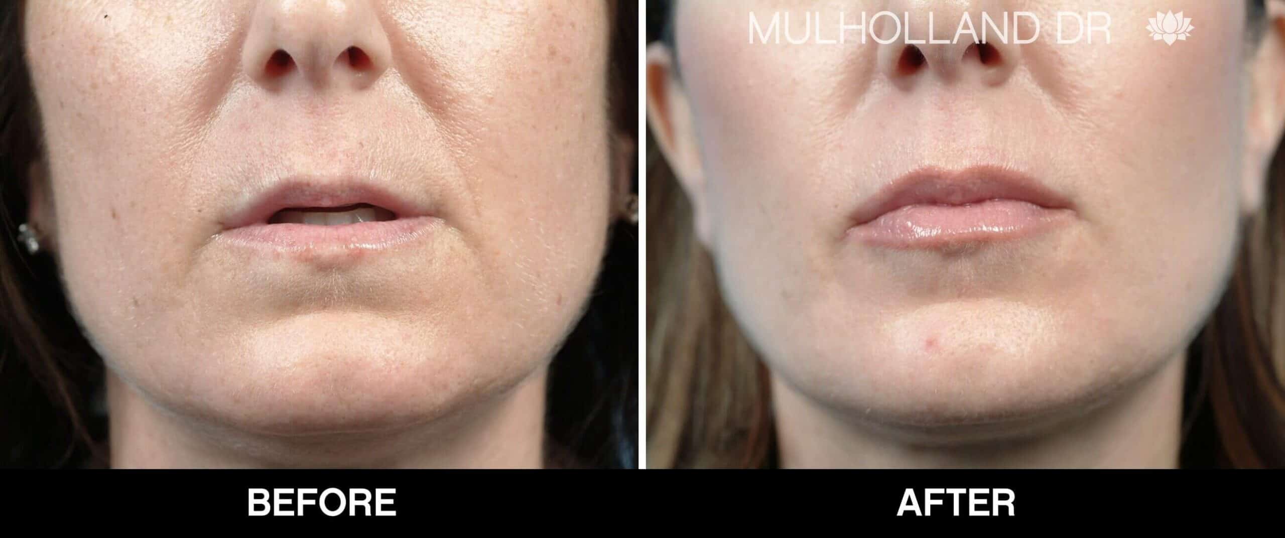 Soft Tissue Fillers - Patient Before and After Gallery – Photo 3