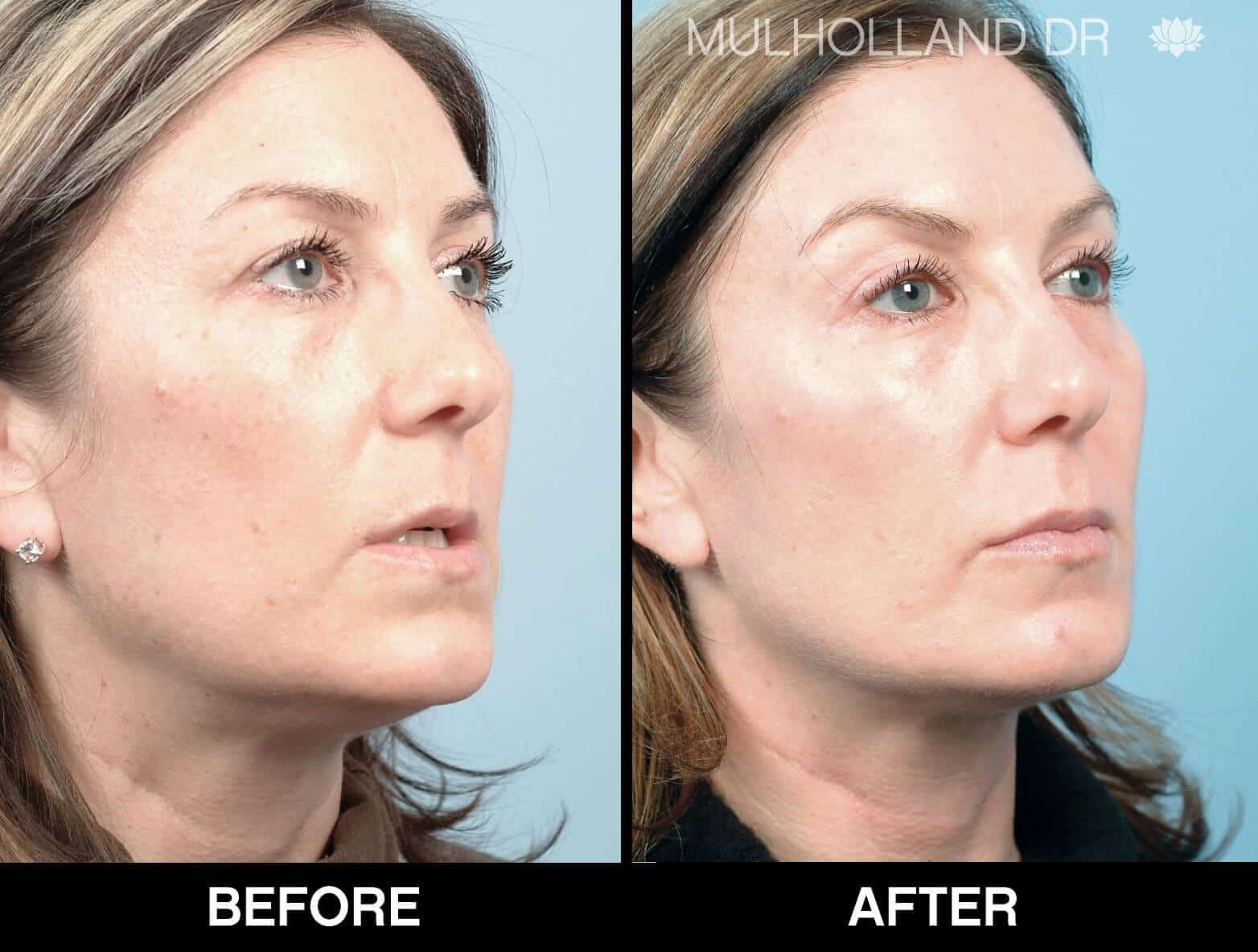 Soft Tissue Fillers - Patient Before and After Gallery – Photo 4