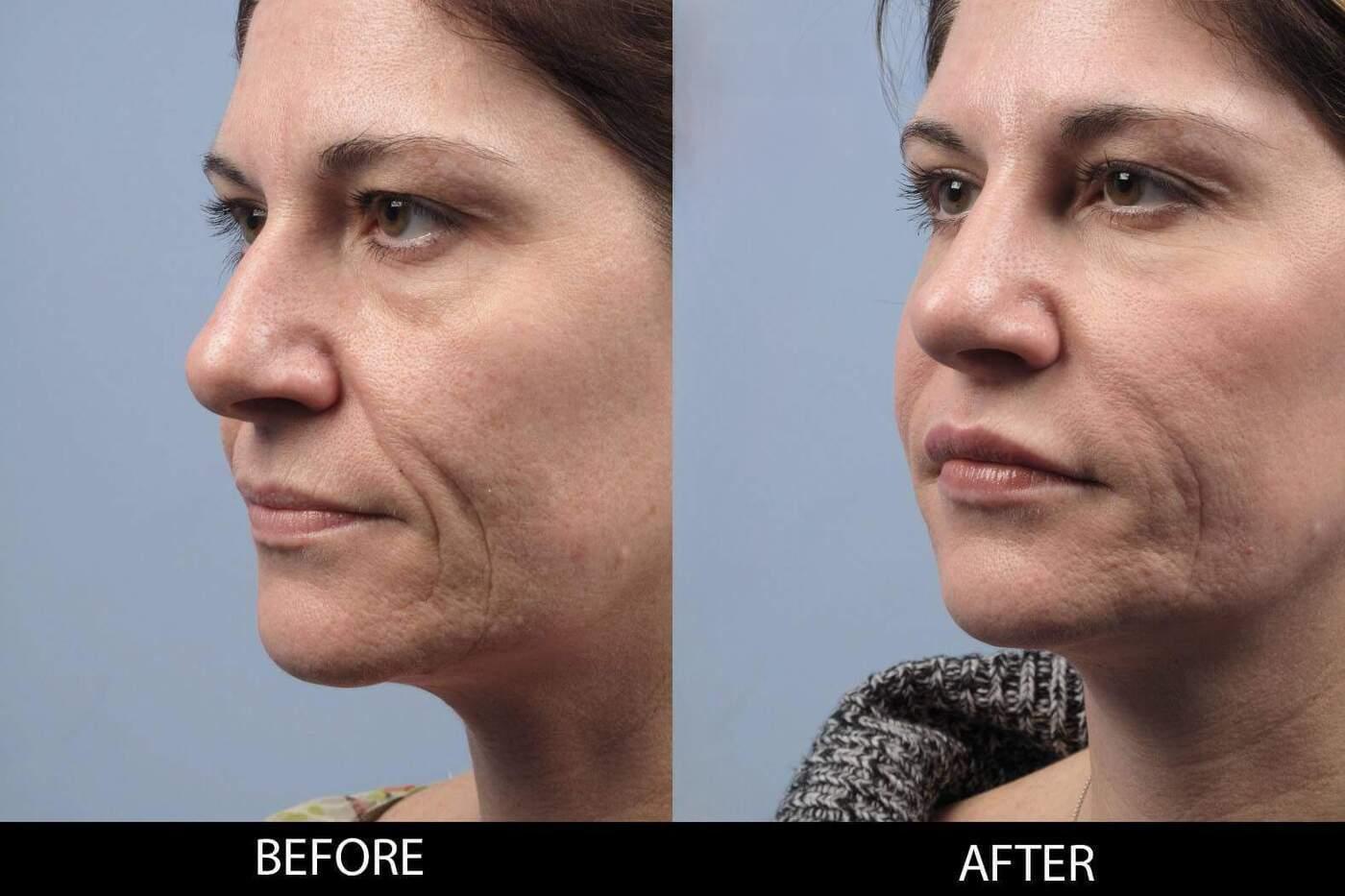 Soft Tissue Fillers - Patient Before and After Gallery – Photo 25