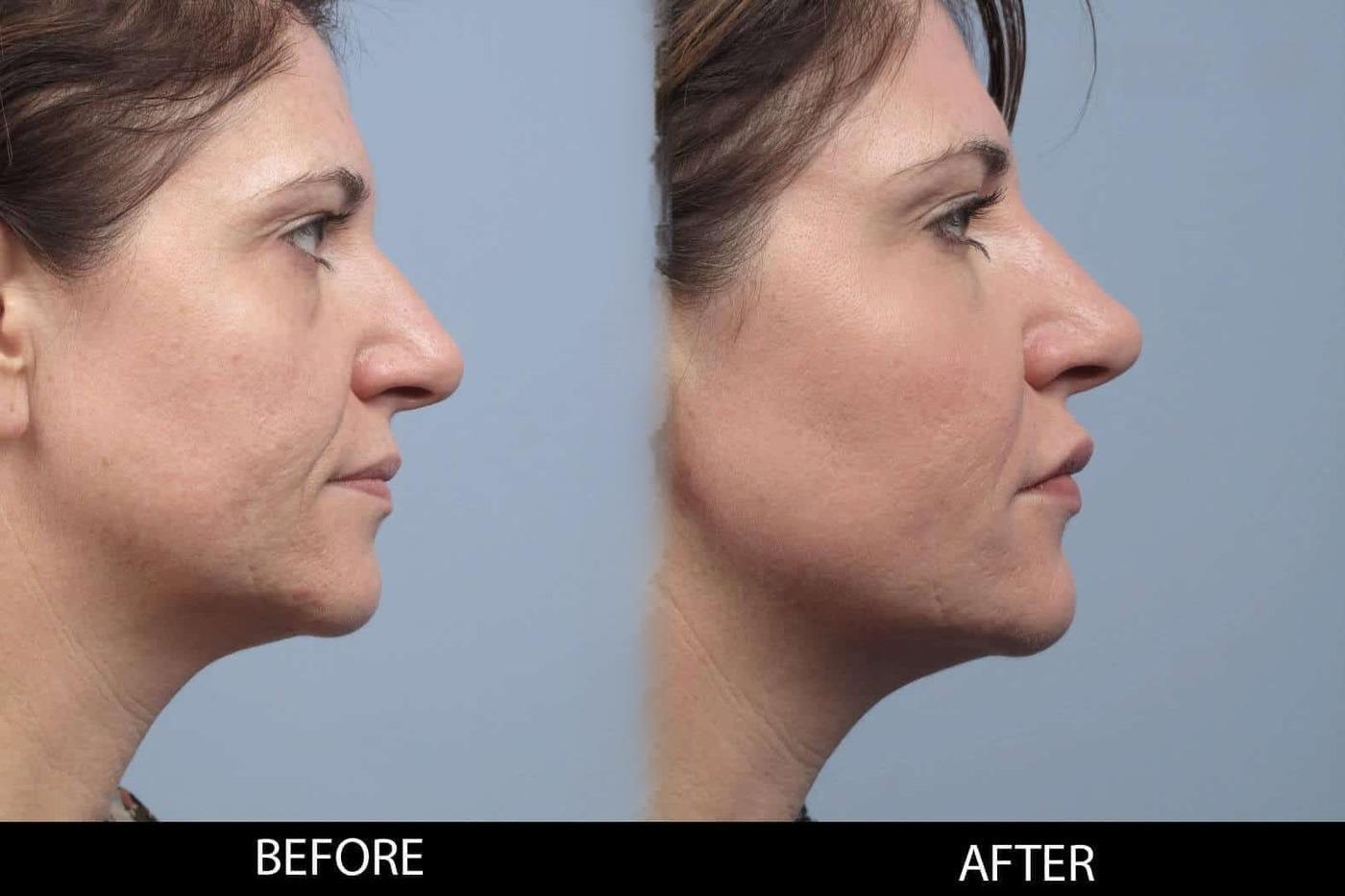 Soft Tissue Fillers - Patient Before and After Gallery – Photo 26