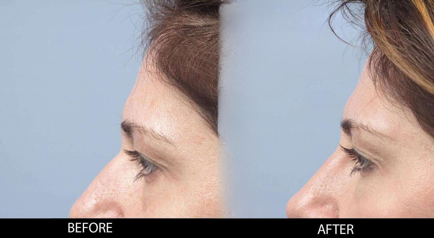 Soft Tissue Fillers - Patient Before and After Gallery – Photo 27