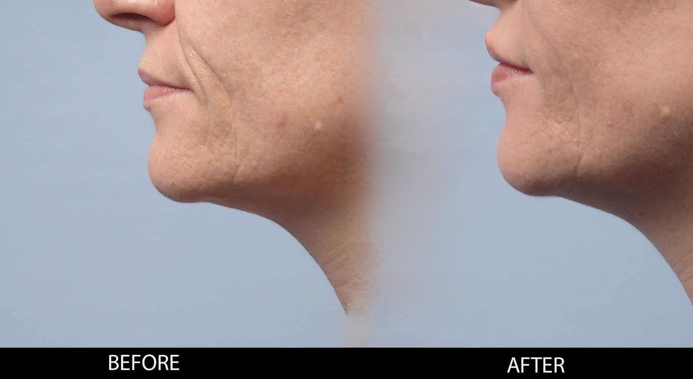 Soft Tissue Fillers - Patient Before and After Gallery – Photo 28
